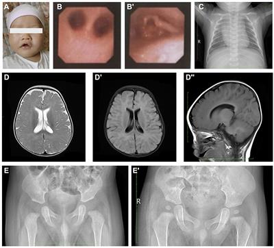 A rare early-onset neonatal case of Birk-Barel syndrome presenting severe obstructive sleep apnea: a case report